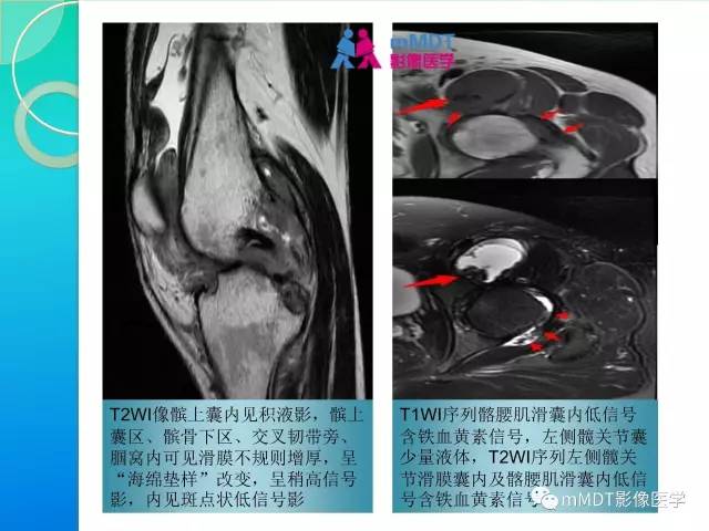 【PPT】7种累及关节滑膜的病变你GET了吗