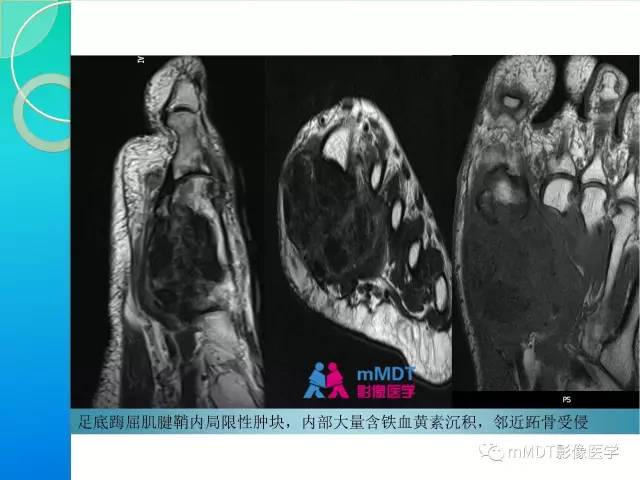 【PPT】7种累及关节滑膜的病变你GET了吗