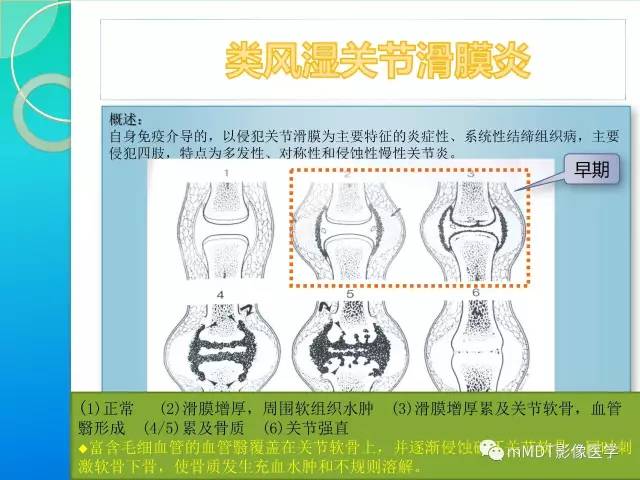 【PPT】7种累及关节滑膜的病变你GET了吗