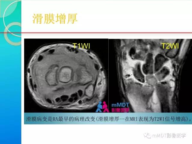【PPT】7种累及关节滑膜的病变你GET了吗