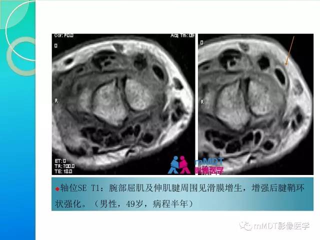 【PPT】7种累及关节滑膜的病变你GET了吗