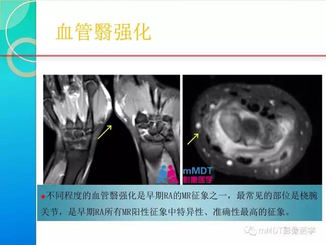 【PPT】7种累及关节滑膜的病变你GET了吗