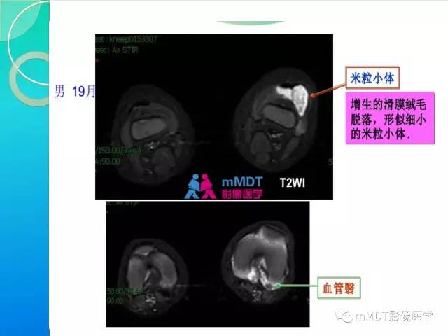 【PPT】7种累及关节滑膜的病变你GET了吗