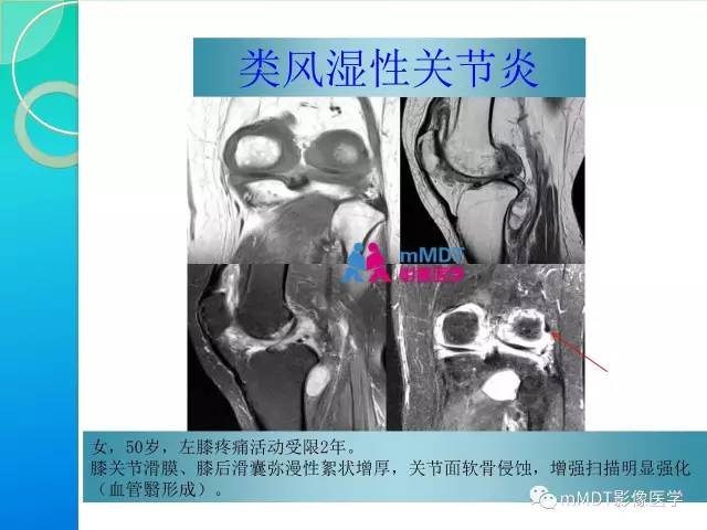 【PPT】7种累及关节滑膜的病变你GET了吗