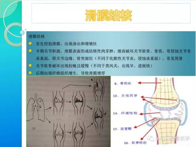 【PPT】7种累及关节滑膜的病变你GET了吗
