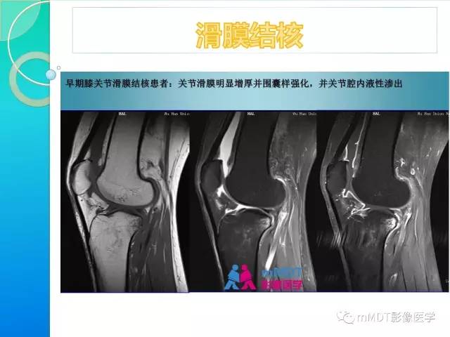 【PPT】7种累及关节滑膜的病变你GET了吗