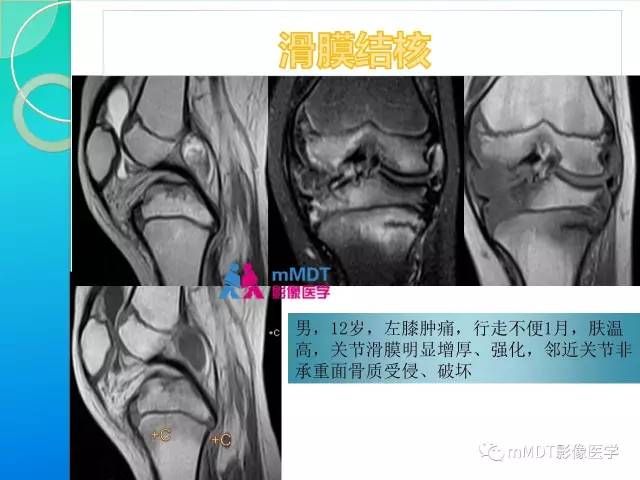 【PPT】7种累及关节滑膜的病变你GET了吗