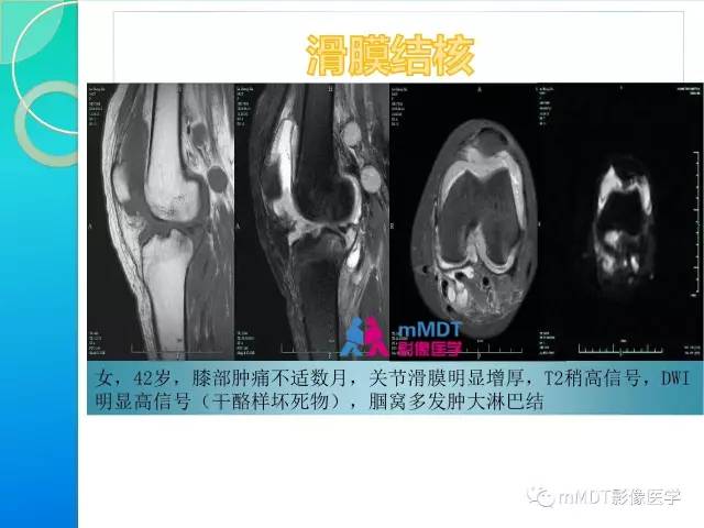 【PPT】7种累及关节滑膜的病变你GET了吗
