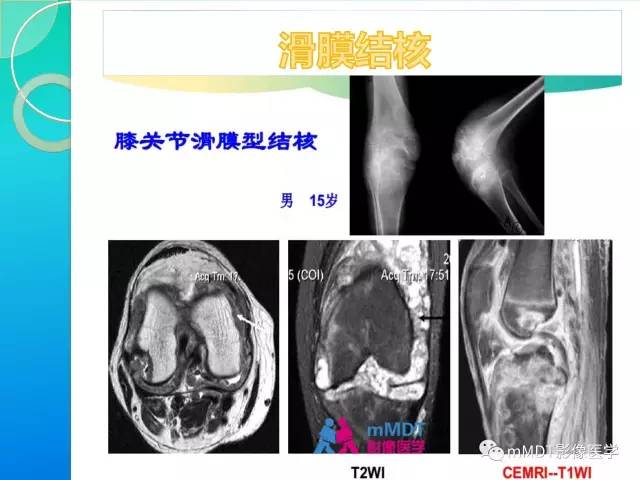 【PPT】7种累及关节滑膜的病变你GET了吗