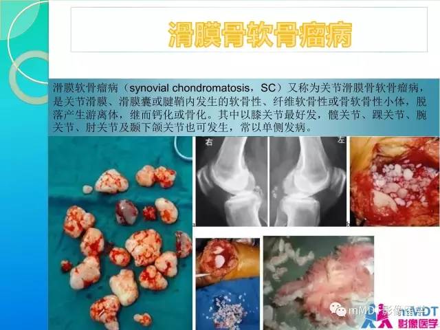 【PPT】7种累及关节滑膜的病变你GET了吗