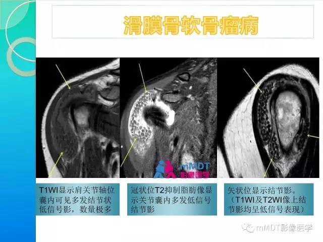 【PPT】7种累及关节滑膜的病变你GET了吗