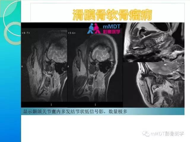 【PPT】7种累及关节滑膜的病变你GET了吗