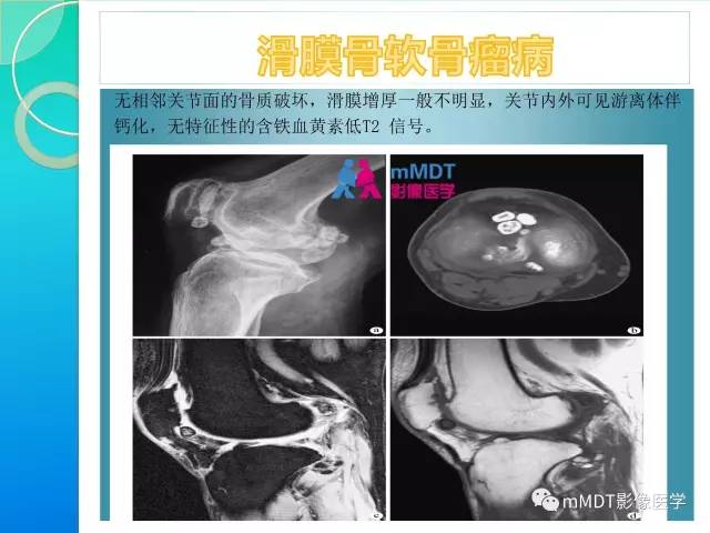 【PPT】7种累及关节滑膜的病变你GET了吗