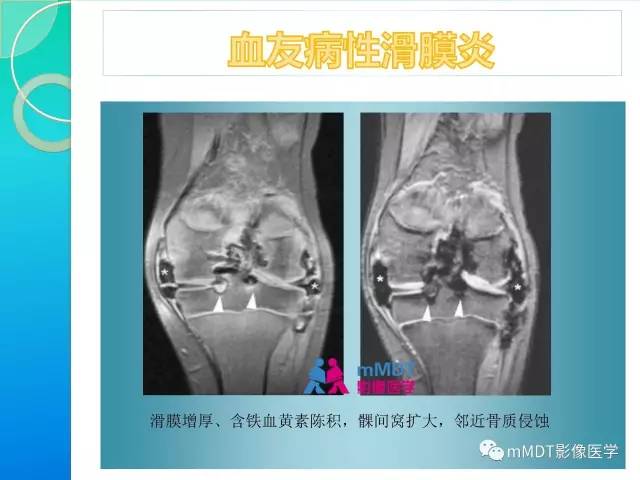 【PPT】7种累及关节滑膜的病变你GET了吗