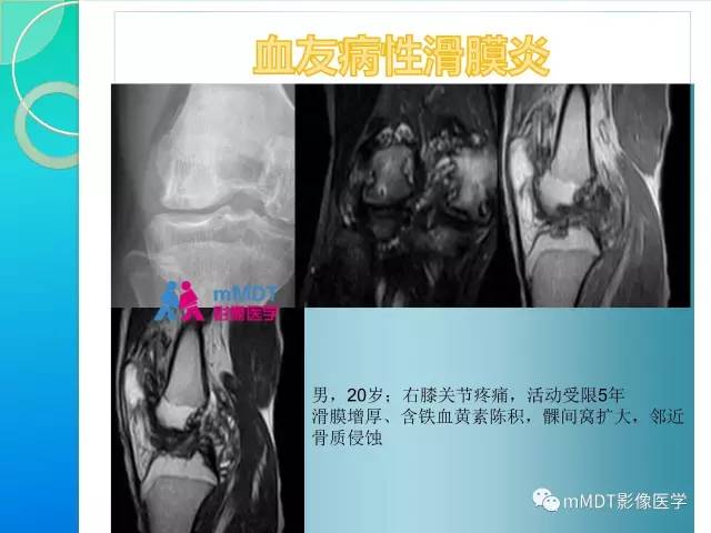 【PPT】7种累及关节滑膜的病变你GET了吗