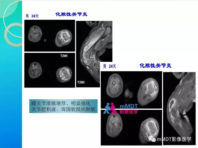 【PPT】7种累及关节滑膜的病变你GET了吗