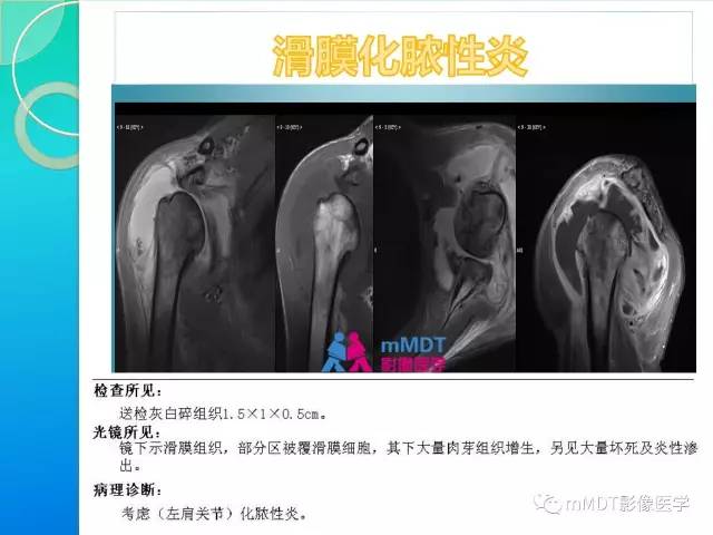 【PPT】7种累及关节滑膜的病变你GET了吗