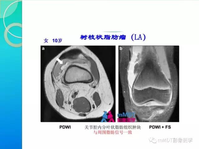 【PPT】7种累及关节滑膜的病变你GET了吗