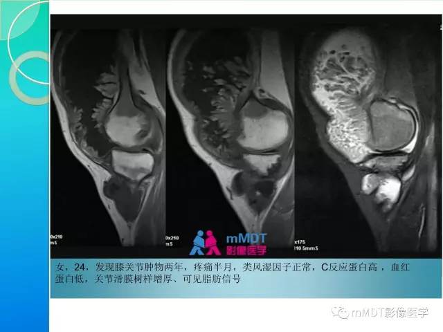 【PPT】7种累及关节滑膜的病变你GET了吗