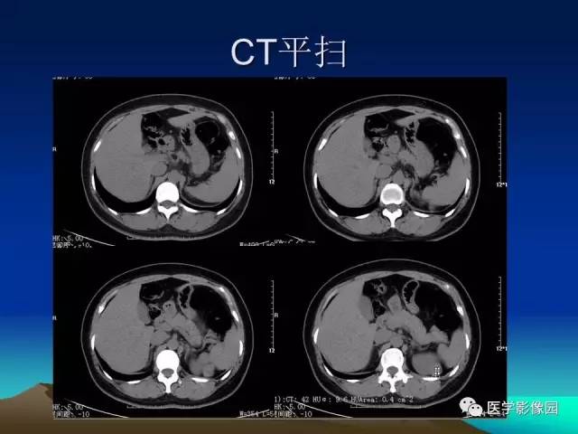 【病例】左肾乏脂肪型血管平滑肌脂肪瘤1例