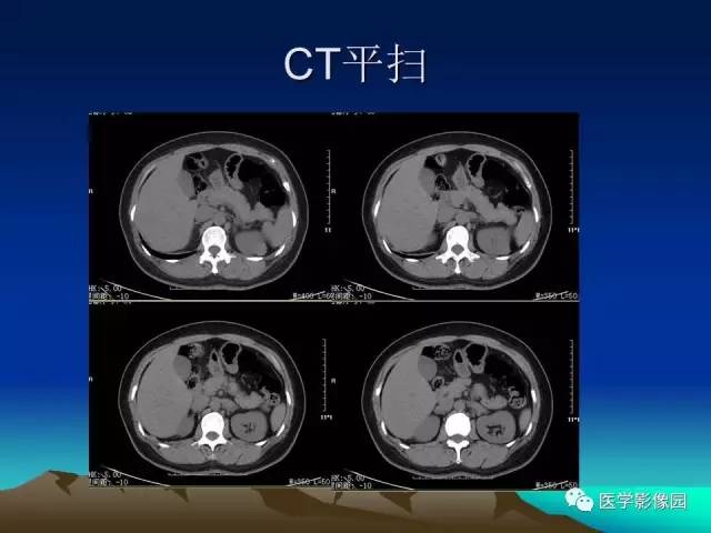 【病例】左肾乏脂肪型血管平滑肌脂肪瘤1例