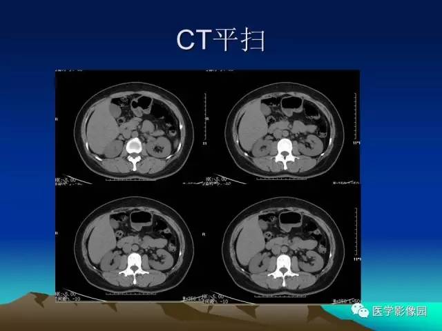 【病例】左肾乏脂肪型血管平滑肌脂肪瘤1例