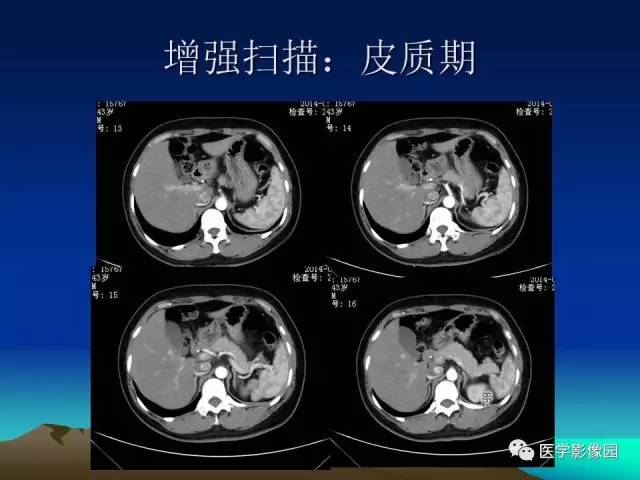 【病例】左肾乏脂肪型血管平滑肌脂肪瘤1例