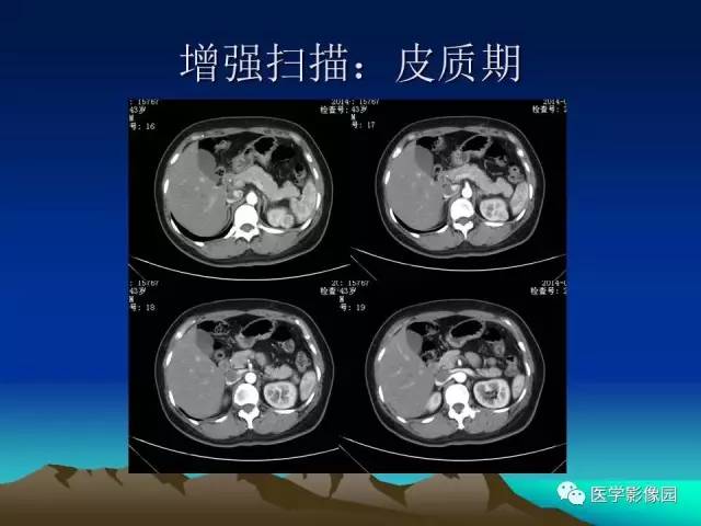 【病例】左肾乏脂肪型血管平滑肌脂肪瘤1例