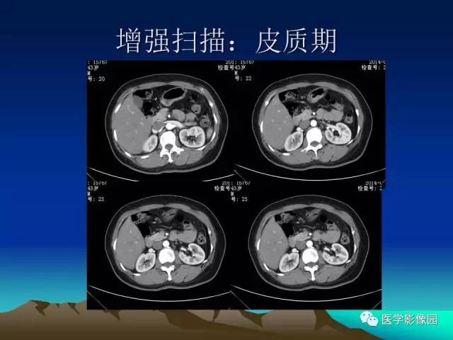 【病例】左肾乏脂肪型血管平滑肌脂肪瘤1例