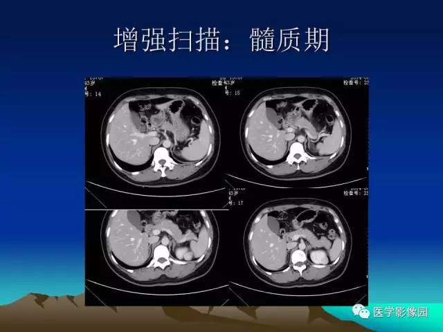 【病例】左肾乏脂肪型血管平滑肌脂肪瘤1例