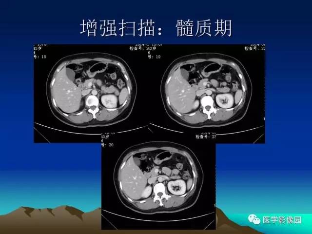 【病例】左肾乏脂肪型血管平滑肌脂肪瘤1例