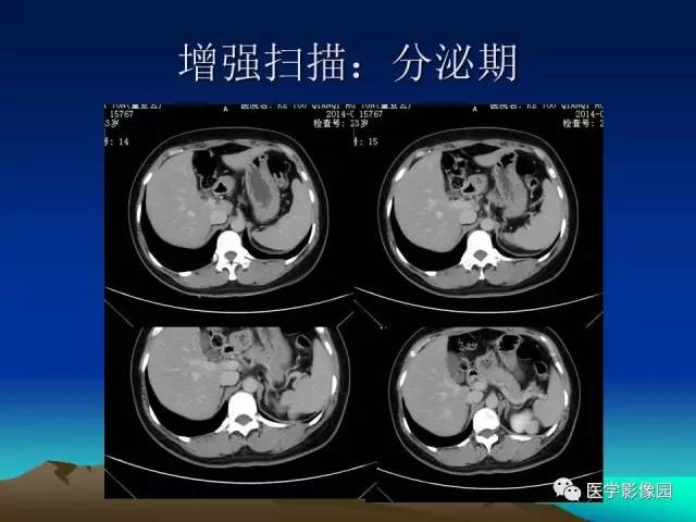 【病例】左肾乏脂肪型血管平滑肌脂肪瘤1例