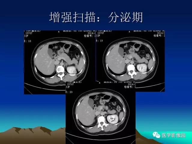 【病例】左肾乏脂肪型血管平滑肌脂肪瘤1例