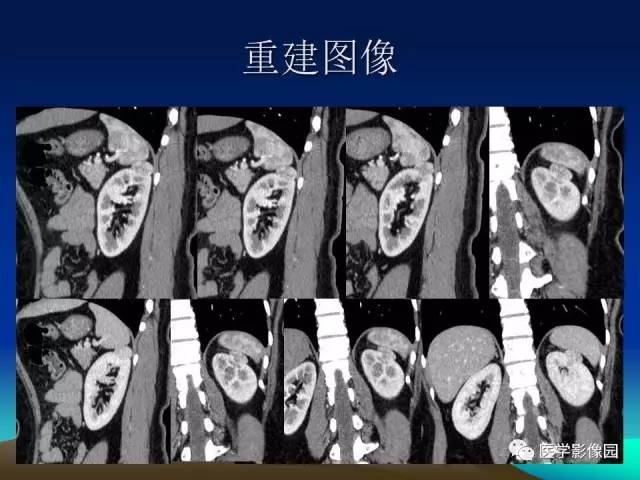 【病例】左肾乏脂肪型血管平滑肌脂肪瘤1例