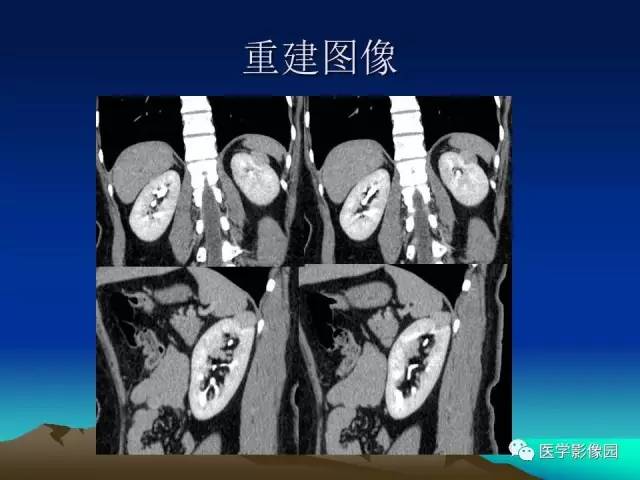 【病例】左肾乏脂肪型血管平滑肌脂肪瘤1例
