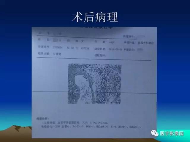 【病例】左肾乏脂肪型血管平滑肌脂肪瘤1例