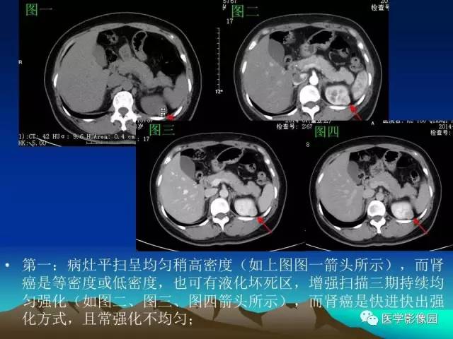 【病例】左肾乏脂肪型血管平滑肌脂肪瘤1例