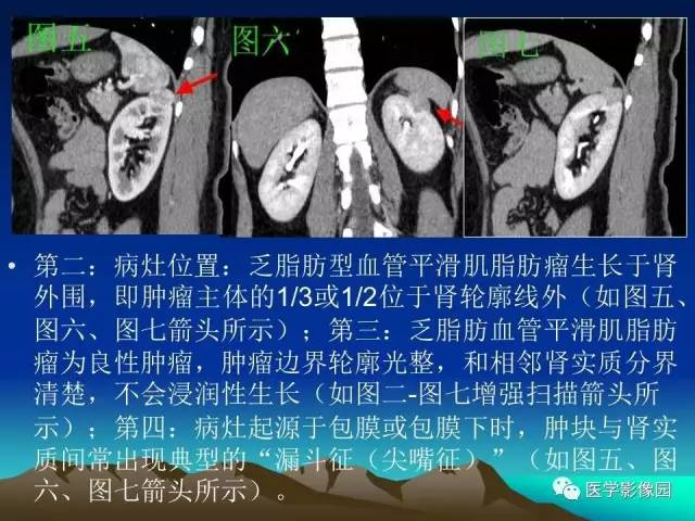 【病例】左肾乏脂肪型血管平滑肌脂肪瘤1例
