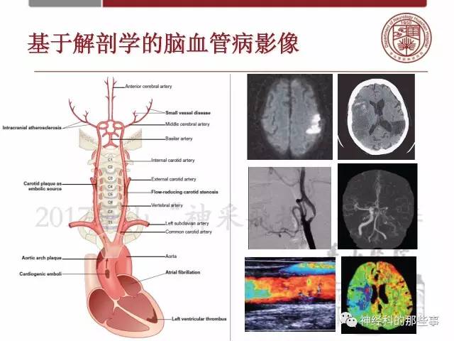 【PPT】脑血管病的影像诊断基础