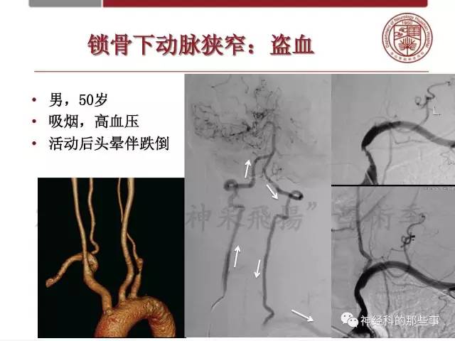 【PPT】脑血管病的影像诊断基础