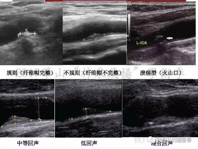 【PPT】脑血管病的影像诊断基础
