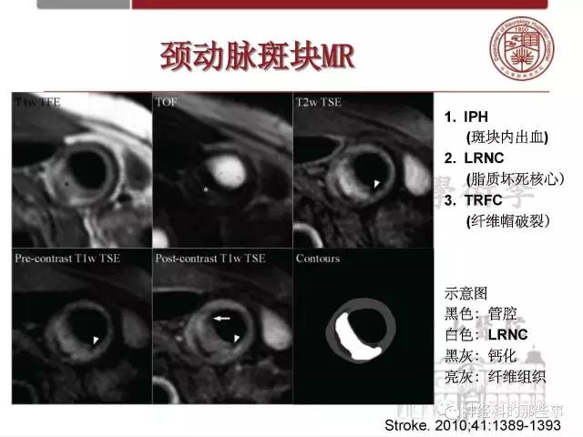【PPT】脑血管病的影像诊断基础