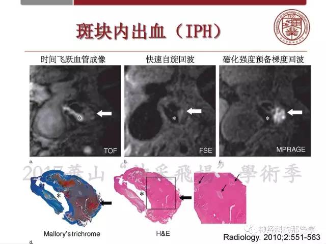 【PPT】脑血管病的影像诊断基础