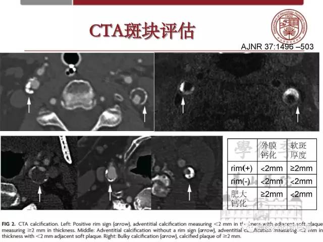 【PPT】脑血管病的影像诊断基础