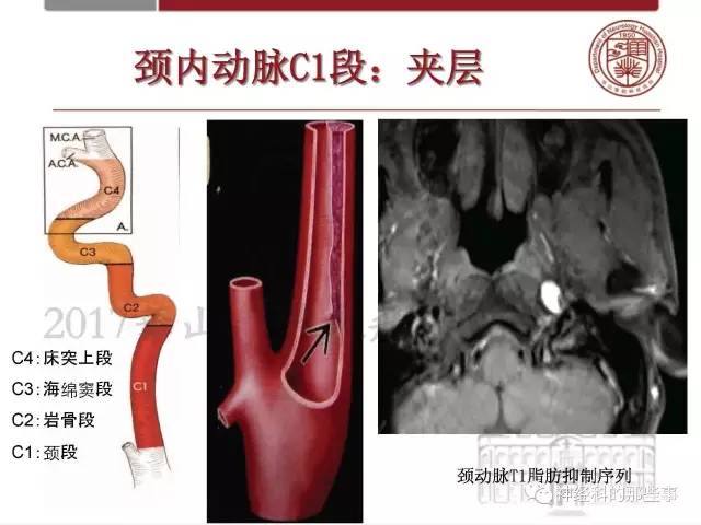 【PPT】脑血管病的影像诊断基础