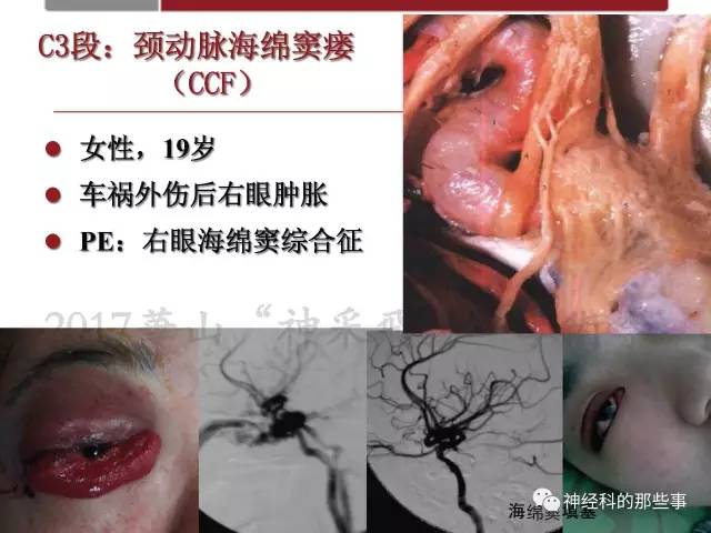 【PPT】脑血管病的影像诊断基础