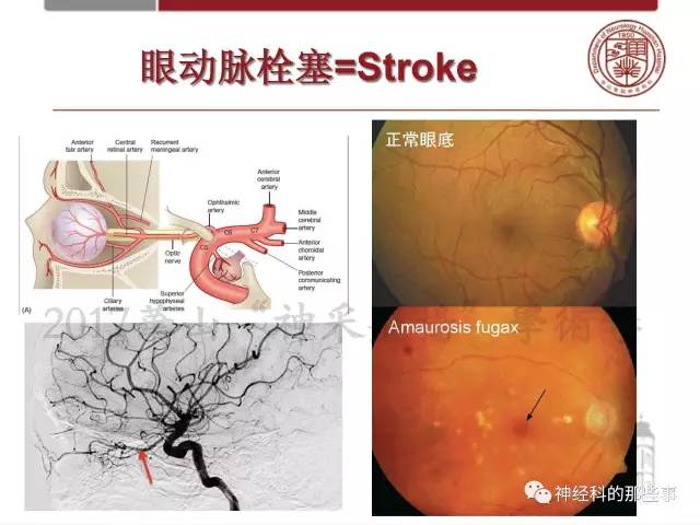 【PPT】脑血管病的影像诊断基础