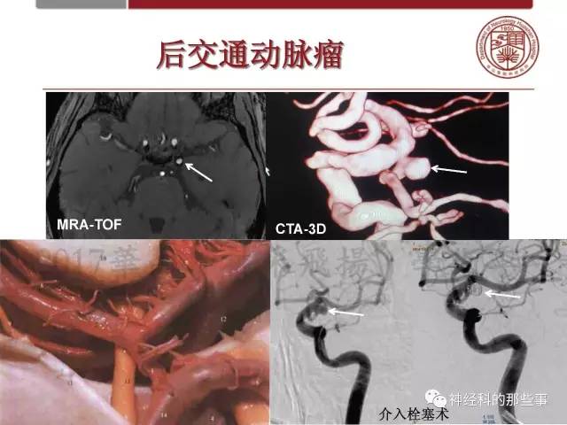 【PPT】脑血管病的影像诊断基础
