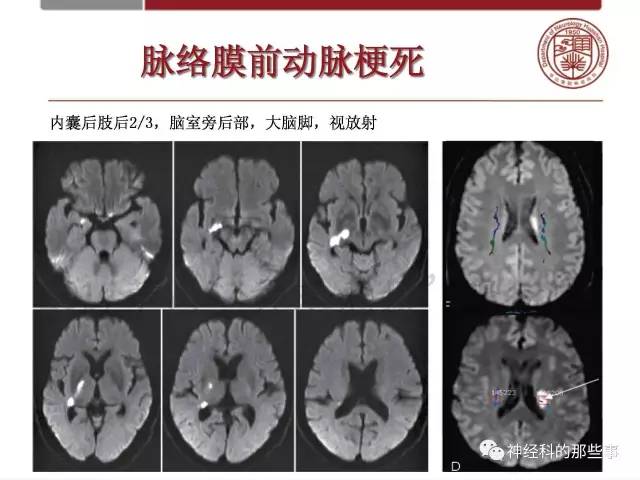 【PPT】脑血管病的影像诊断基础