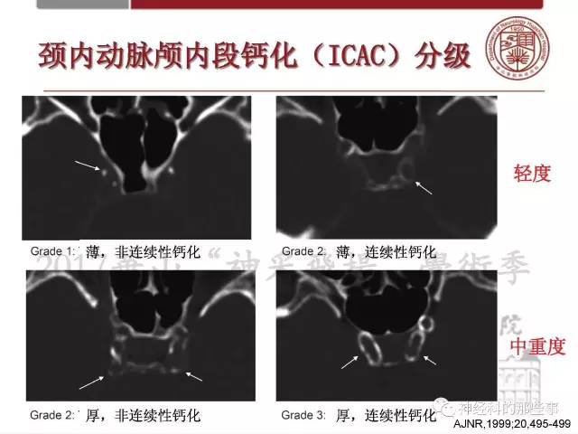 【PPT】脑血管病的影像诊断基础
